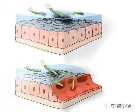 莆田福德消化專家教你認(rèn)識(shí)慢性淺表性胃炎